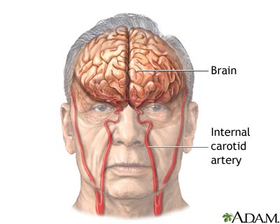Stroke - Series Stroke - Series