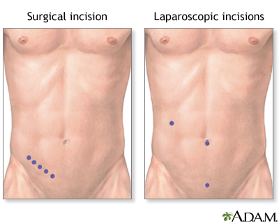 Incision Incision