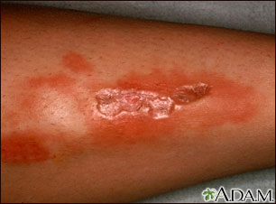 Necrobiosis lipoidica diabeticorum - leg Necrobiosis lipoidica diabeticorum - leg