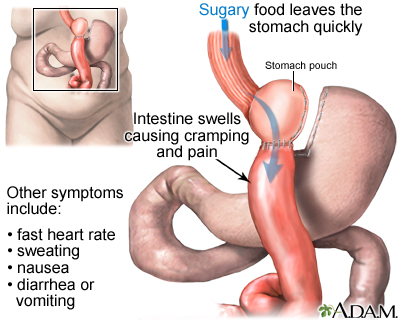 Dumping syndrome Dumping syndrome