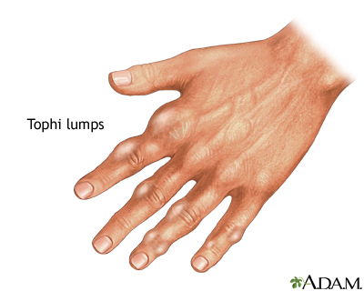 Tophi gout in hand Tophi gout in hand