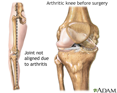 Knee misaligned due to arthritis Knee misaligned due to arthritis
