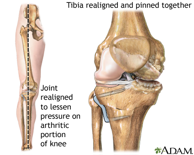 Knee after tibial osteotomy Knee after tibial osteotomy
