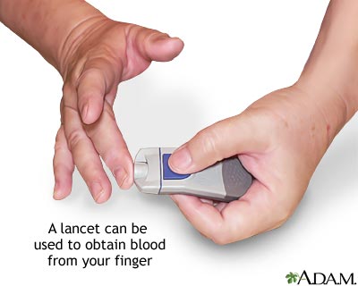 Monitoring blood glucose - Prick your finger Monitoring blood glucose - Prick your finger