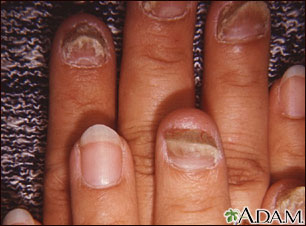 Onycholysis Onycholysis