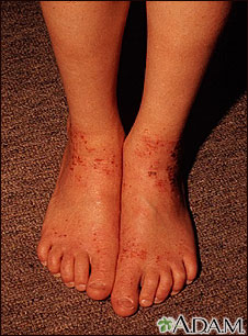 Atopy on the ankles Atopy on the ankles