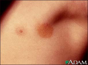 Urticaria pigmentosa in the armpit Urticaria pigmentosa in the armpit