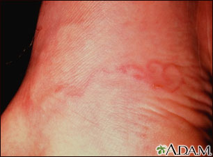 Cutaneous larva migrans Cutaneous larva migrans