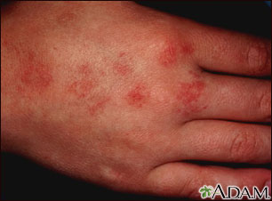 Angioma serpiginosum Angioma serpiginosum