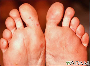 Hand, foot, and mouth disease on the soles Hand, foot, and mouth disease on the soles