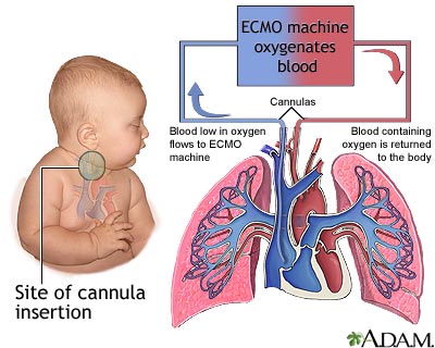 ECMO ECMO