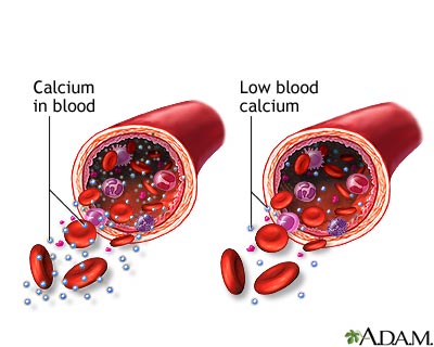 Hypocalcemia Hypocalcemia