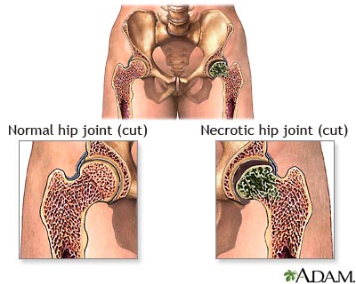 Aseptic necrosis Aseptic necrosis
