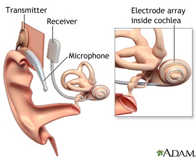 Cochlear implant Cochlear implant