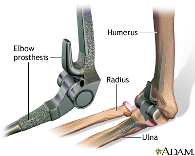 Elbow prosthesis Elbow prosthesis