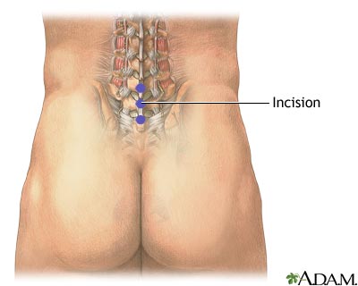 Microdiskectomy - Incision Microdiskectomy - Incision
