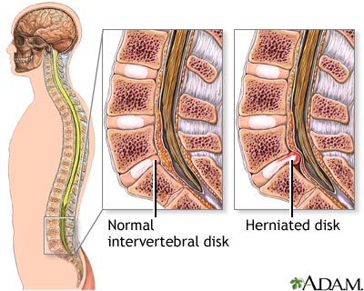 Microdiskectomy - series Microdiskectomy - series