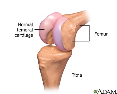 Partial knee replacement - series Partial knee replacement - series