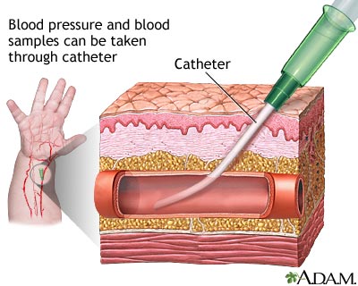 Peripheral arterial line Peripheral arterial line