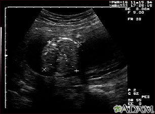 Ultrasound, normal fetus - abdomen measurements Ultrasound, normal fetus - abdomen measurements