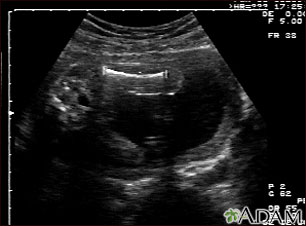Ultrasound, normal fetus - femur measurement Ultrasound, normal fetus - femur measurement
