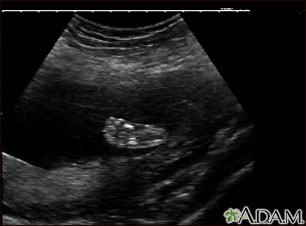Ultrasound, normal fetus - foot Ultrasound, normal fetus - foot