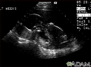 Ultrasound, normal fetus - profile view Ultrasound, normal fetus - profile view
