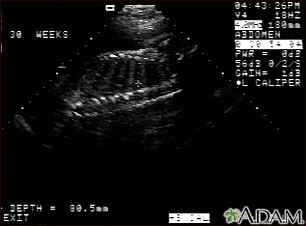 Ultrasound, normal fetus - spine and ribs Ultrasound, normal fetus - spine and ribs