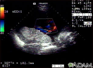 Ultrasound, color - normal umbilical cord Ultrasound, color - normal umbilical cord