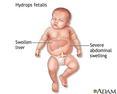 Hydrops fetalis Hydrops fetalis