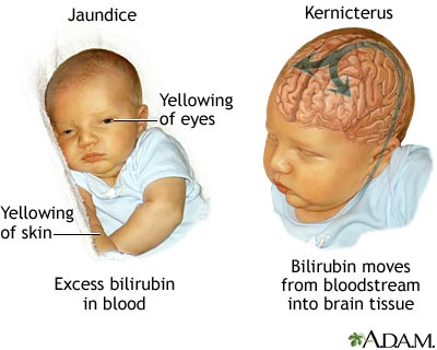Kernicterus Kernicterus