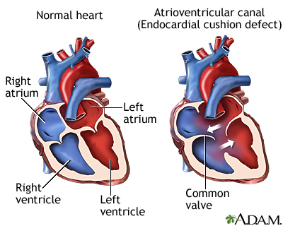 Atrioventricular canal (endocardial cushion defect) Atrioventricular canal (endocardial cushion defect)