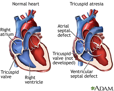 Tricuspid atresia Tricuspid atresia