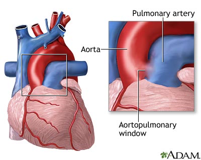 Aortopulmonary window Aortopulmonary window