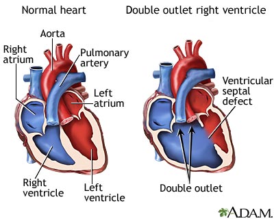 Doble salida ventricular derecha Doble salida ventricular derecha