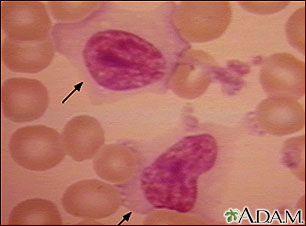 Mononucleosis - photomicrograph of cell Mononucleosis - photomicrograph of cell