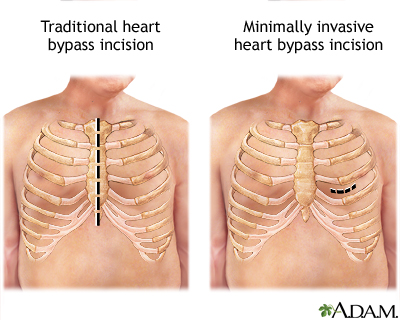 Heart bypass surgery incision Heart bypass surgery incision