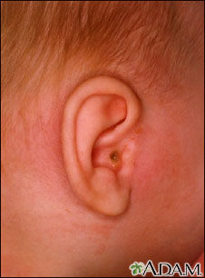 Mastoiditis - side view of head Mastoiditis - side view of head