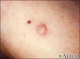 Keratoacanthoma Keratoacanthoma