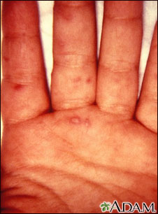 Hand, foot, and mouth disease on the hand Hand, foot, and mouth disease on the hand