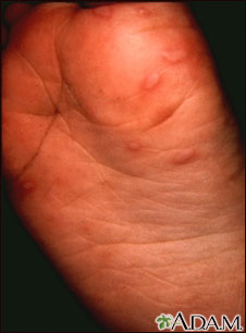 Hand, foot, and mouth disease on the foot Hand, foot, and mouth disease on the foot