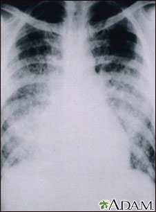 Chickenpox, acute pneumonia - chest X-ray Chickenpox, acute pneumonia - chest X-ray