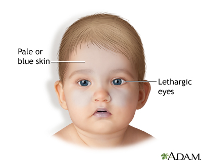 Shaken baby symptoms Shaken baby symptoms