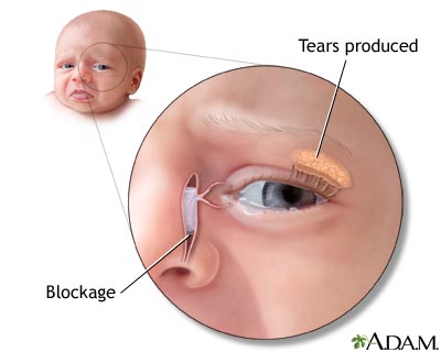 Blocked tear duct Blocked tear duct