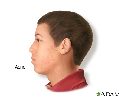 Acne Acne