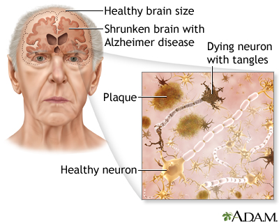 Alzheimer disease Alzheimer disease
