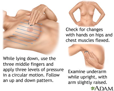 Breast self-exam Breast self-exam