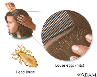 Head lice Head lice