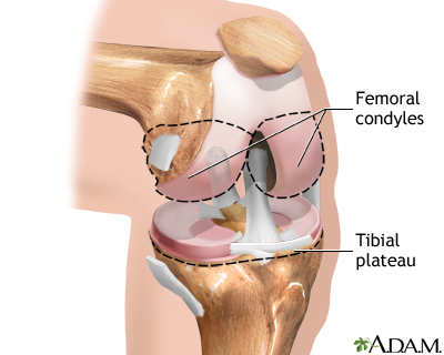Knee joint replacement - Series Knee joint replacement - Series