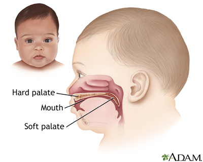 Cleft lip repair - series Cleft lip repair - series